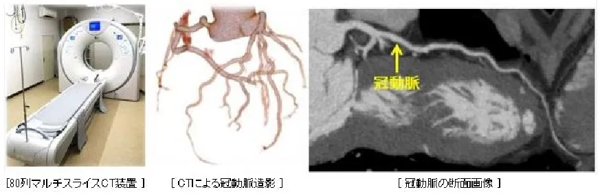 80列マルチスライスCT装置、CTによる冠動脈造影、冠動脈の断面画像